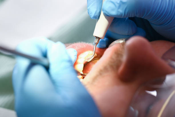 Best Emergency Wisdom Tooth Extraction in New Roads, LA