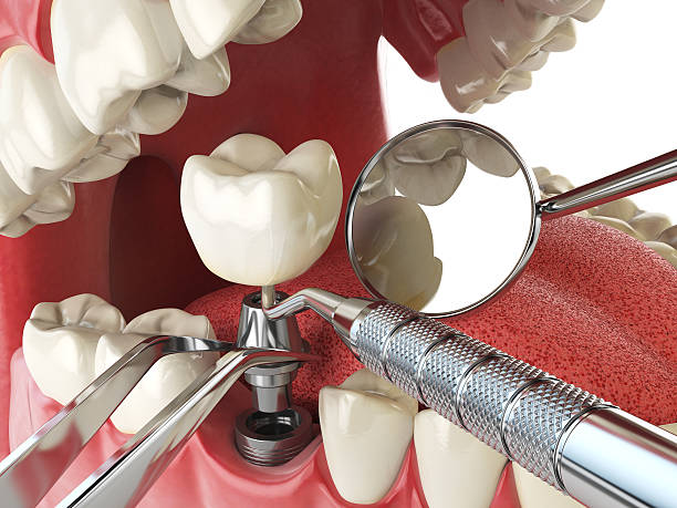 Best Broken or Chipped Tooth Repair in New Roads, LA